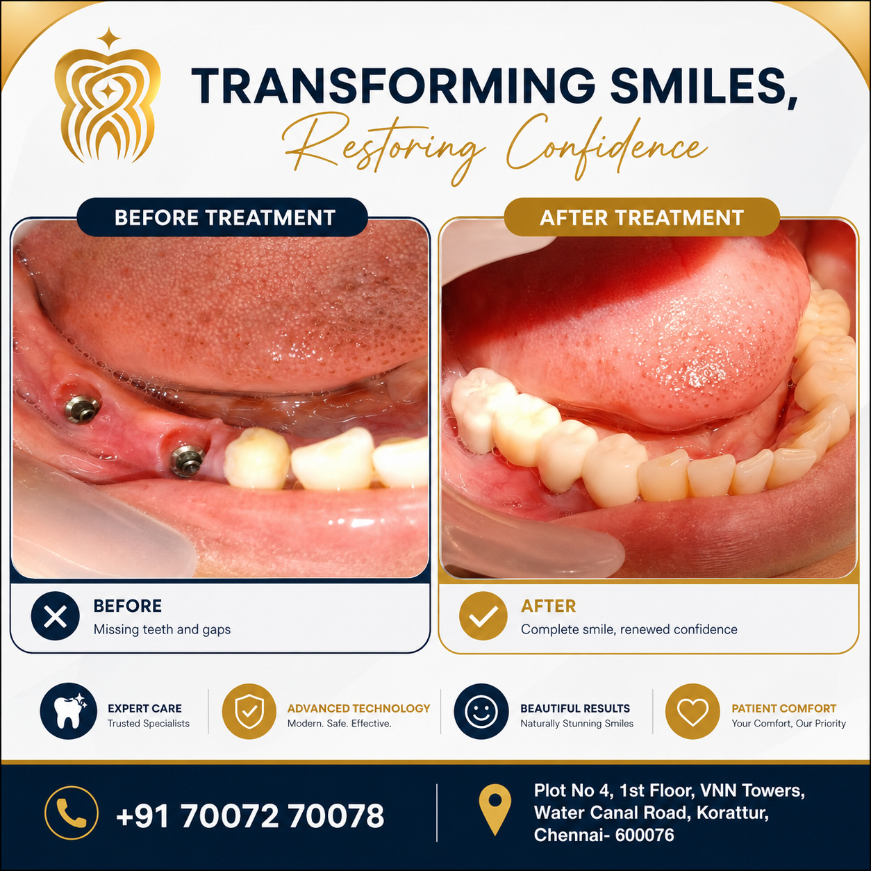 Tooth Replacement In Chennai